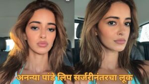 अनन्या पांडे लिप सर्जरीनंतरचा लूक
