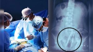 30 वर्षीय तरुणाच्या गुदद्वारात अडकला 2 फूट प्लास्टिक पाईप; शस्त्रक्रियेने बाहेर काढले