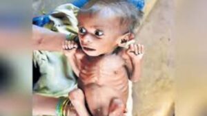 मेळघाटात कुपोषणाची भीषण स्थिती; जूनपासून ६५ बालकांचा मृत्यू, हायकोर्टाची सरकारला कडक फटकार