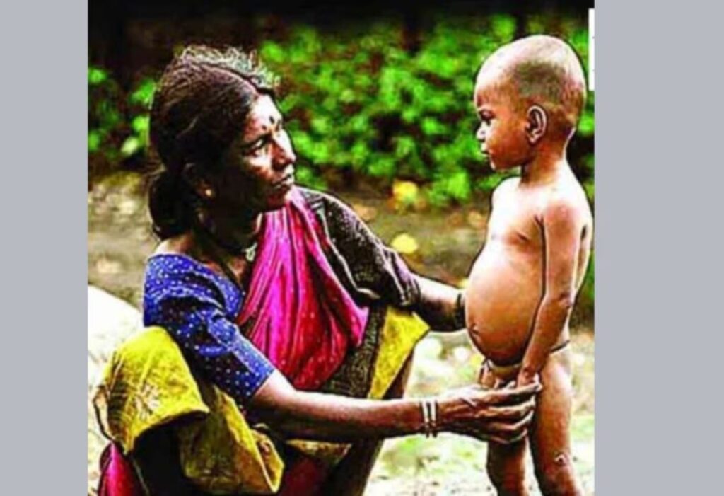 Maharashtra Malnutrition: राज्यात 1.37 लाख मुले कुपोषित; उच्च न्यायालयात राज्य सरकारची धक्कादायक कबुली
