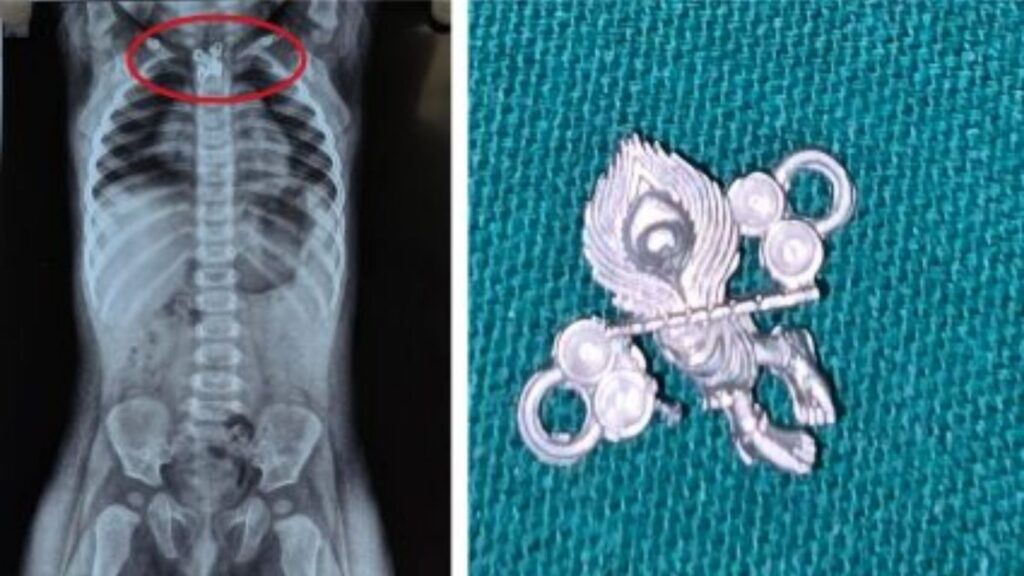 Mumbai Hospital News: सात महिन्यांच्या बाळाने गिळले कृष्ण लॉकेट मुंबईतील डॉक्टरांनी एंडोस्कोपीतून वाचवला जीव