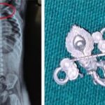 Mumbai Hospital News: सात महिन्यांच्या बाळाने गिळले कृष्ण लॉकेट मुंबईतील डॉक्टरांनी एंडोस्कोपीतून वाचवला जीव